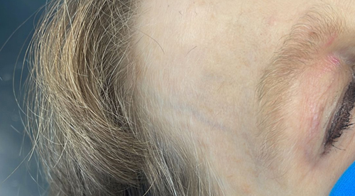 Hydra Dew Facial in NY